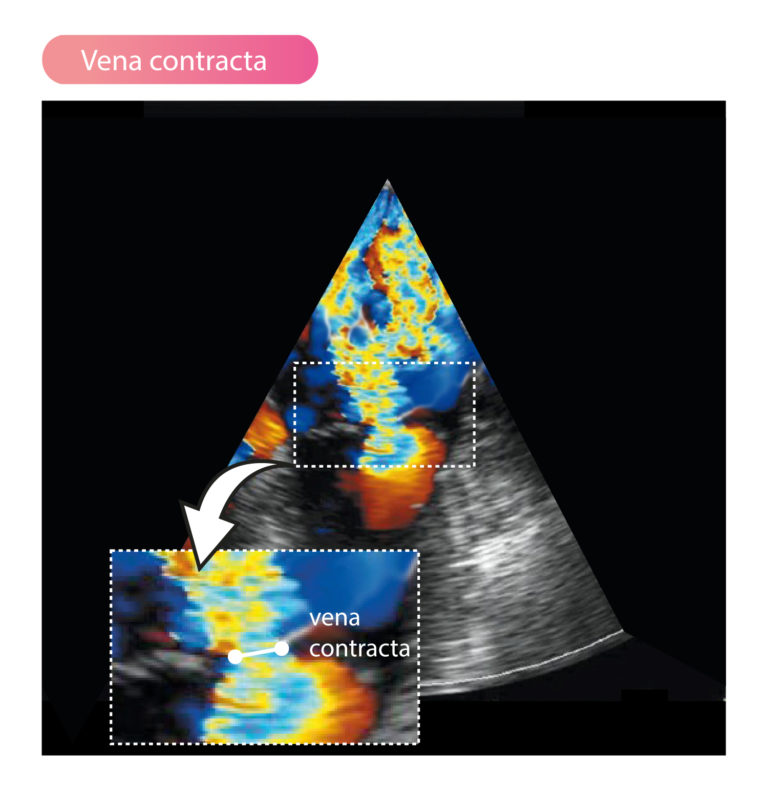 Mitral regurgitation Echocardiography, diagnosis, grading, severity