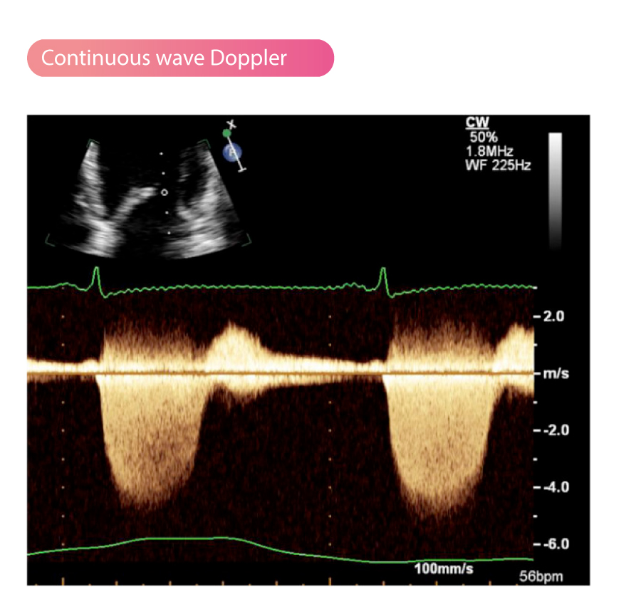 pulsed wave doppler