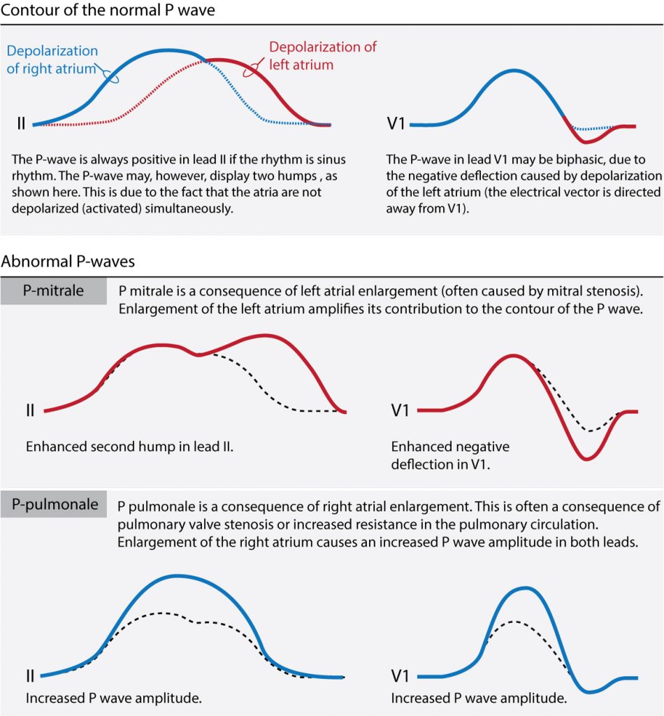 Figure 1. The ECG contour of the normal P-wave, P mitrale (left atrial enlargement) and P pulmonale (right atrial enlargement)