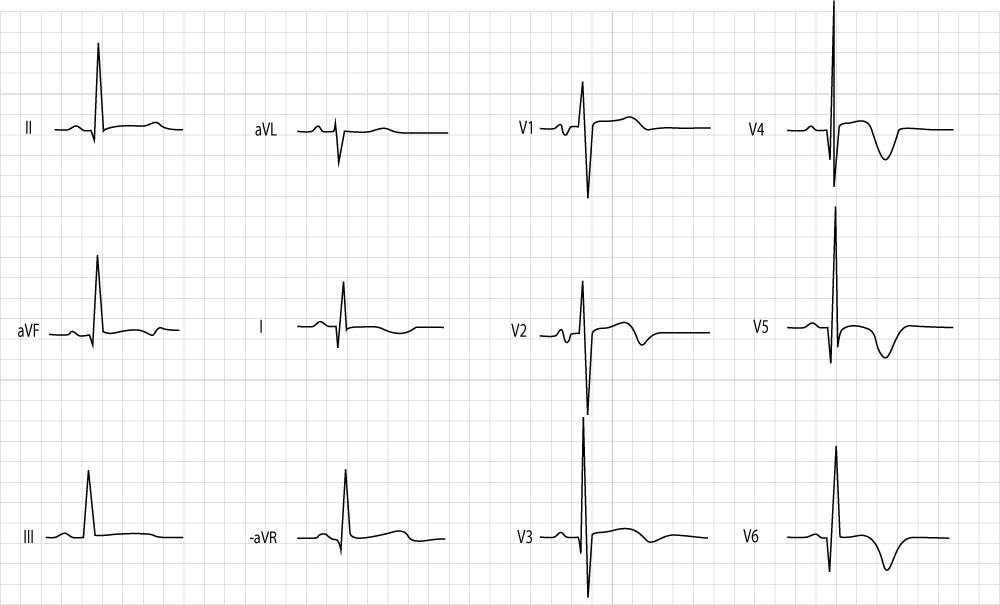 Normal Pediatric Ecg