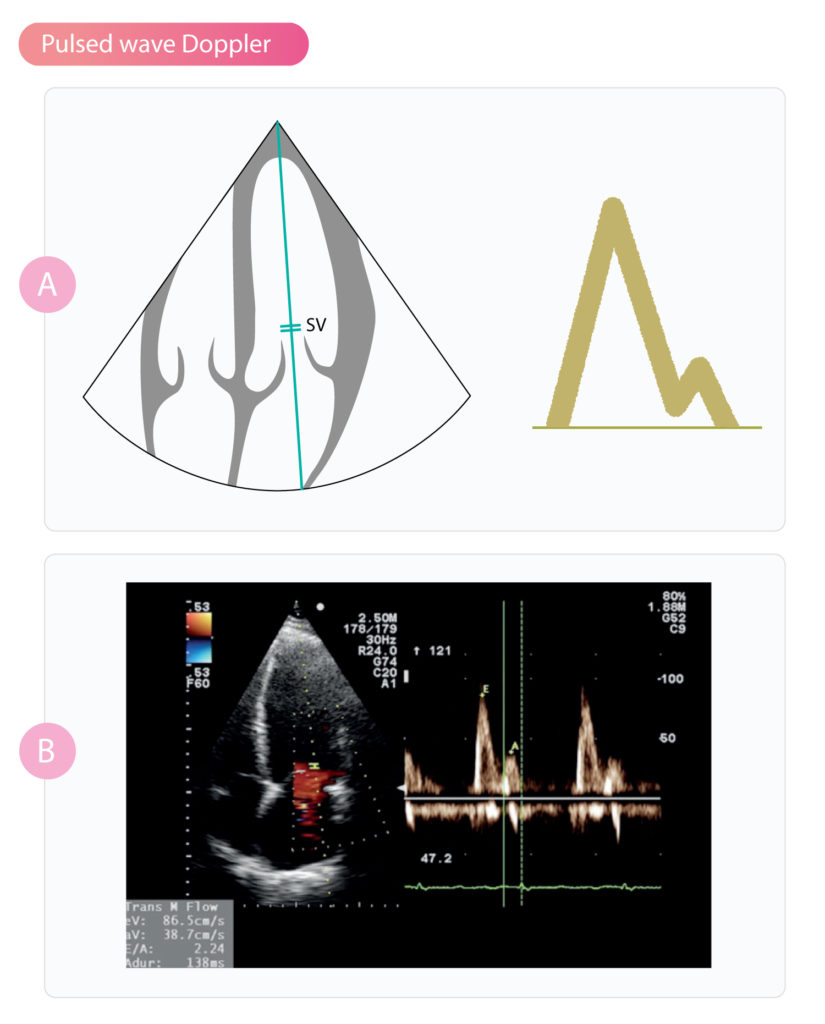 pulsed wave doppler