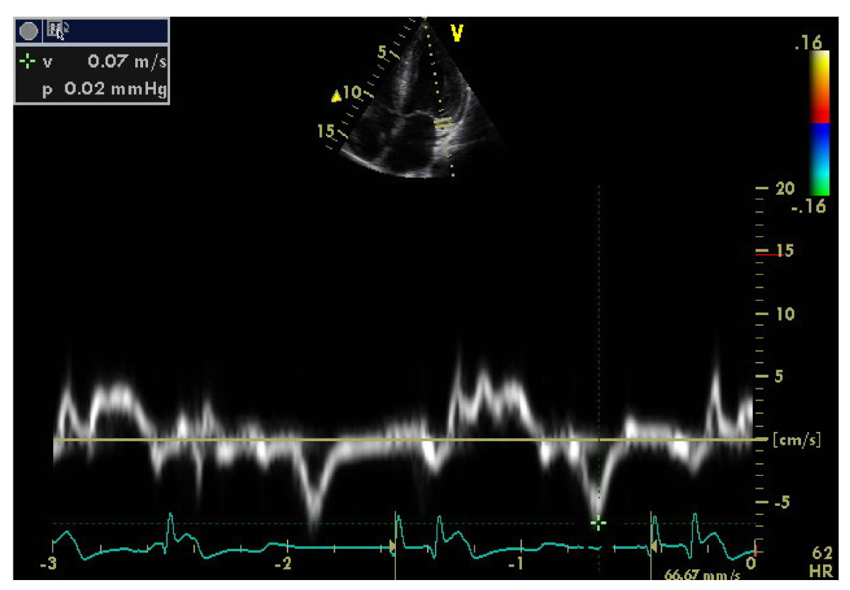 Tissue Doppler (Tissue Velocity Imaging) – The Cardiovascular