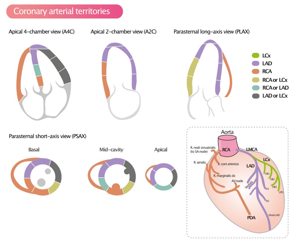 Figure 3. Assignment of the 17 myocardial segments to the territories of the left anterior descending (LAD), right coronary artery (RCA), and the left circumflex coronary artery (LCX).