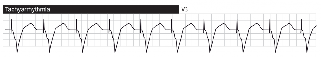 Tachyarrhythmia with ventricular pacing.