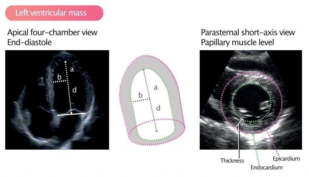 Left ventricular mass and volume (size) – ECG & ECHO