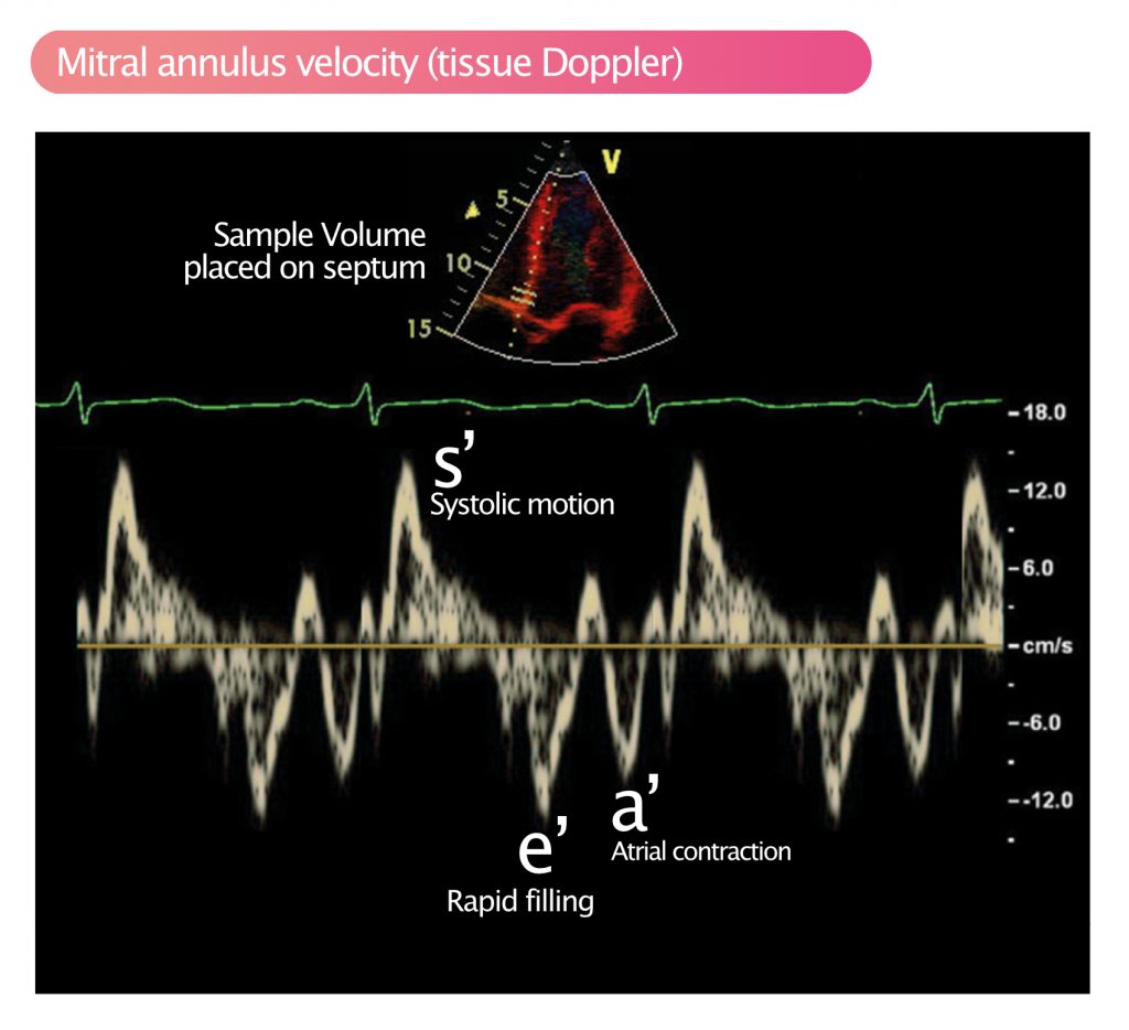 global longitudinal strain calculation