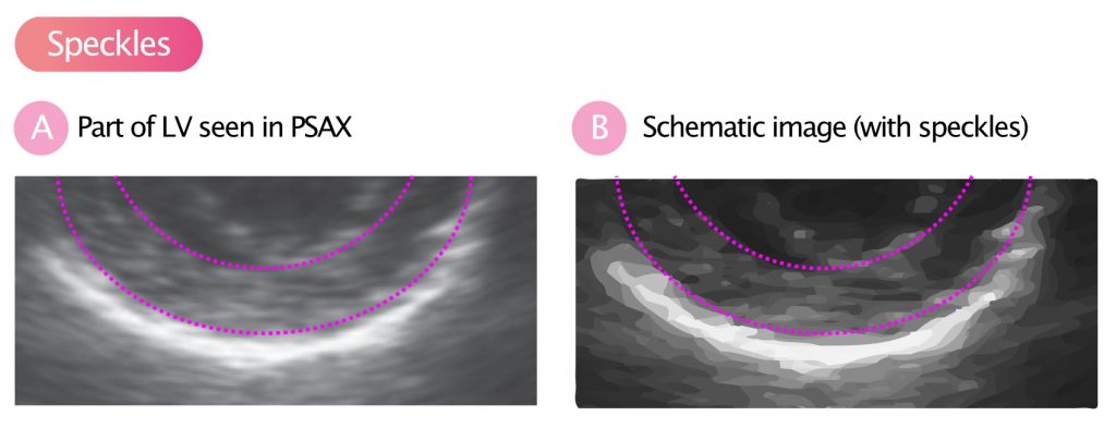 Value of Speckle Tracking–Based Deformation Analysis in Screening