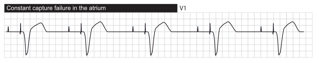 Failure to capture. The pacemaker paces in the atrium but P-waves are not visible, suggesting that the atria are not depolarized.