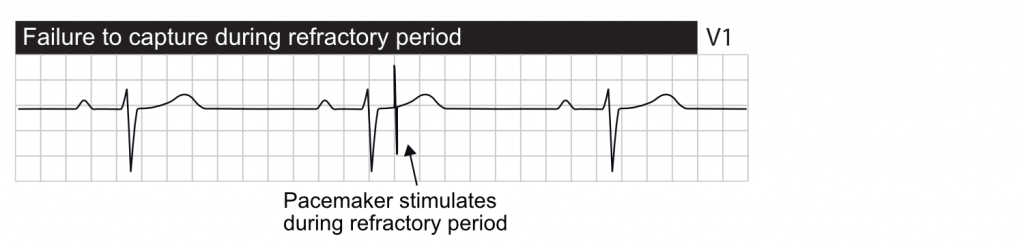 Failure to capture during refractory period.