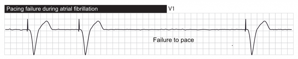 Failure to pace.