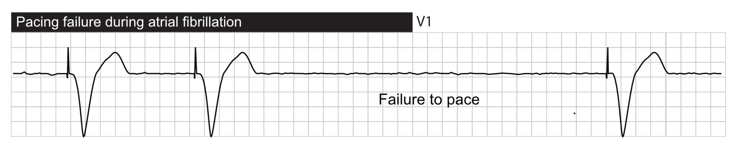 pacemaker failure to capture ekg