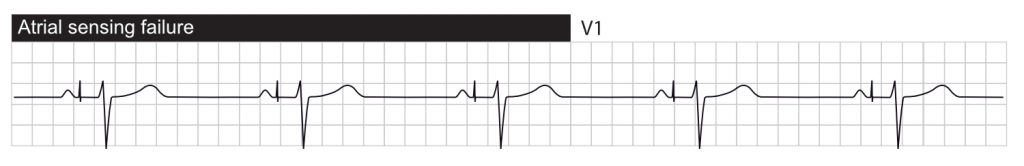 transvenous pacemaker failure to capture