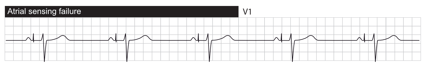 pacemaker failure to capture ekg