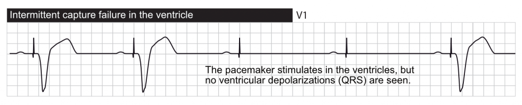 ventricular paced failure to capture