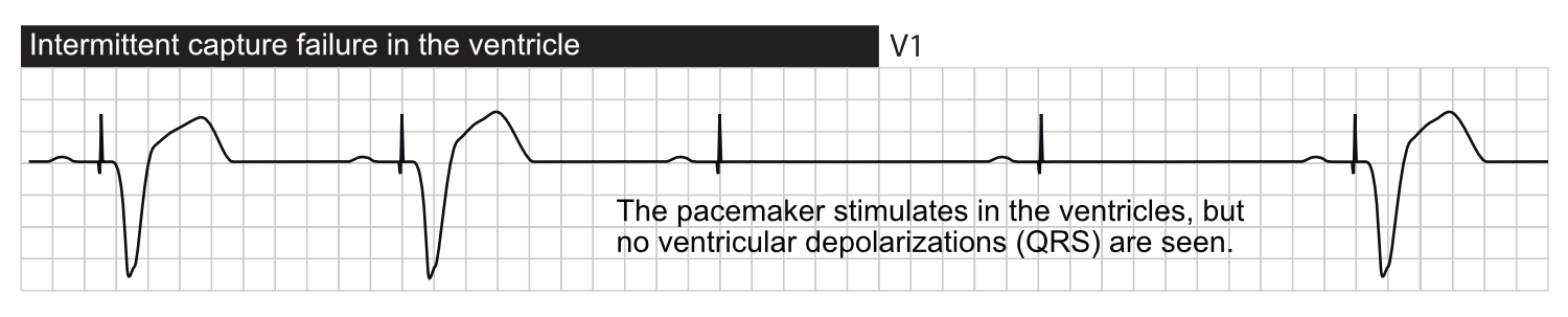 failure to capture ecg