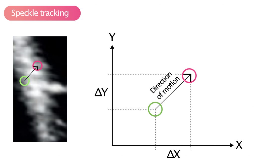 Strain, strain rate and speckle tracking: Myocardial deformation