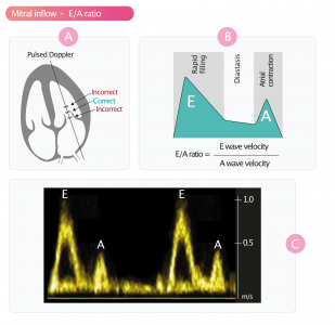 Figure 1. Measurement of mitral inflow velocities.