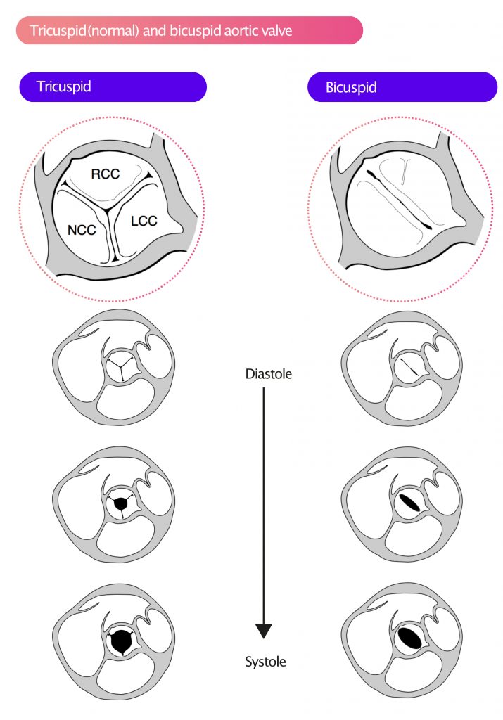 aortic valve echo