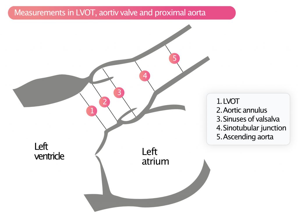 Figure 5. Measurements in LVOT, aortiv valve and proximal aorta.