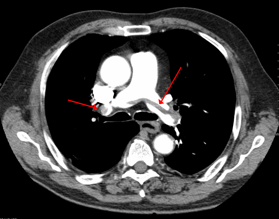 Pulmonary Embolism PE Causes Symptoms Diagnosis Treatment