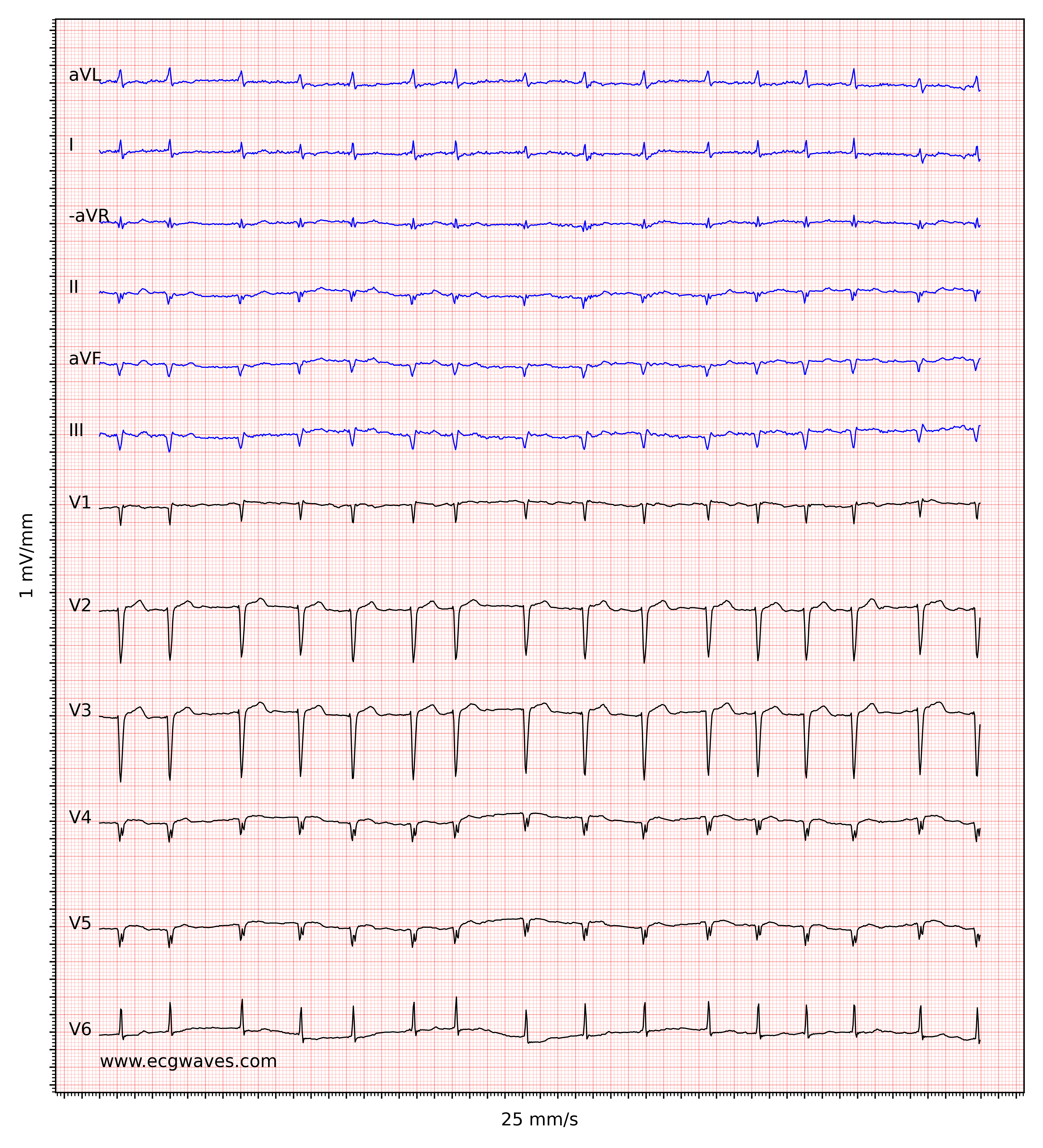 Irregular Heartbeat Ekg