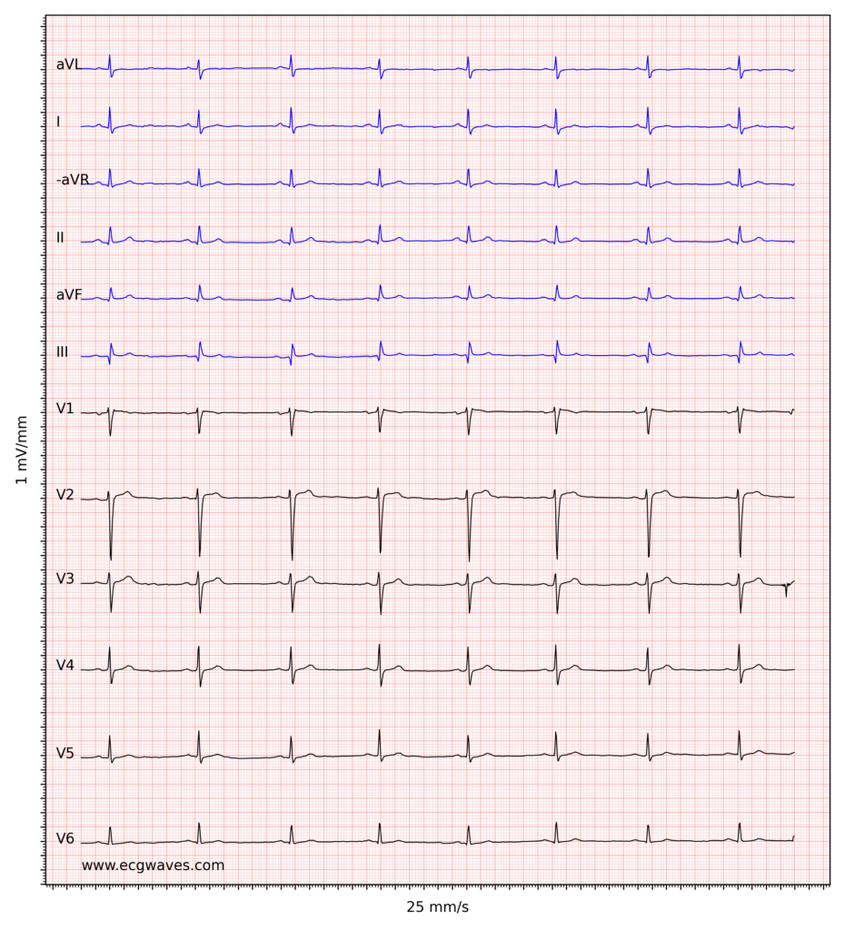 Figure 3. Sinus bradycardia. The small q-waves in inferior leads (II, aVF, III) are not significant. Low voltage in limb leads.