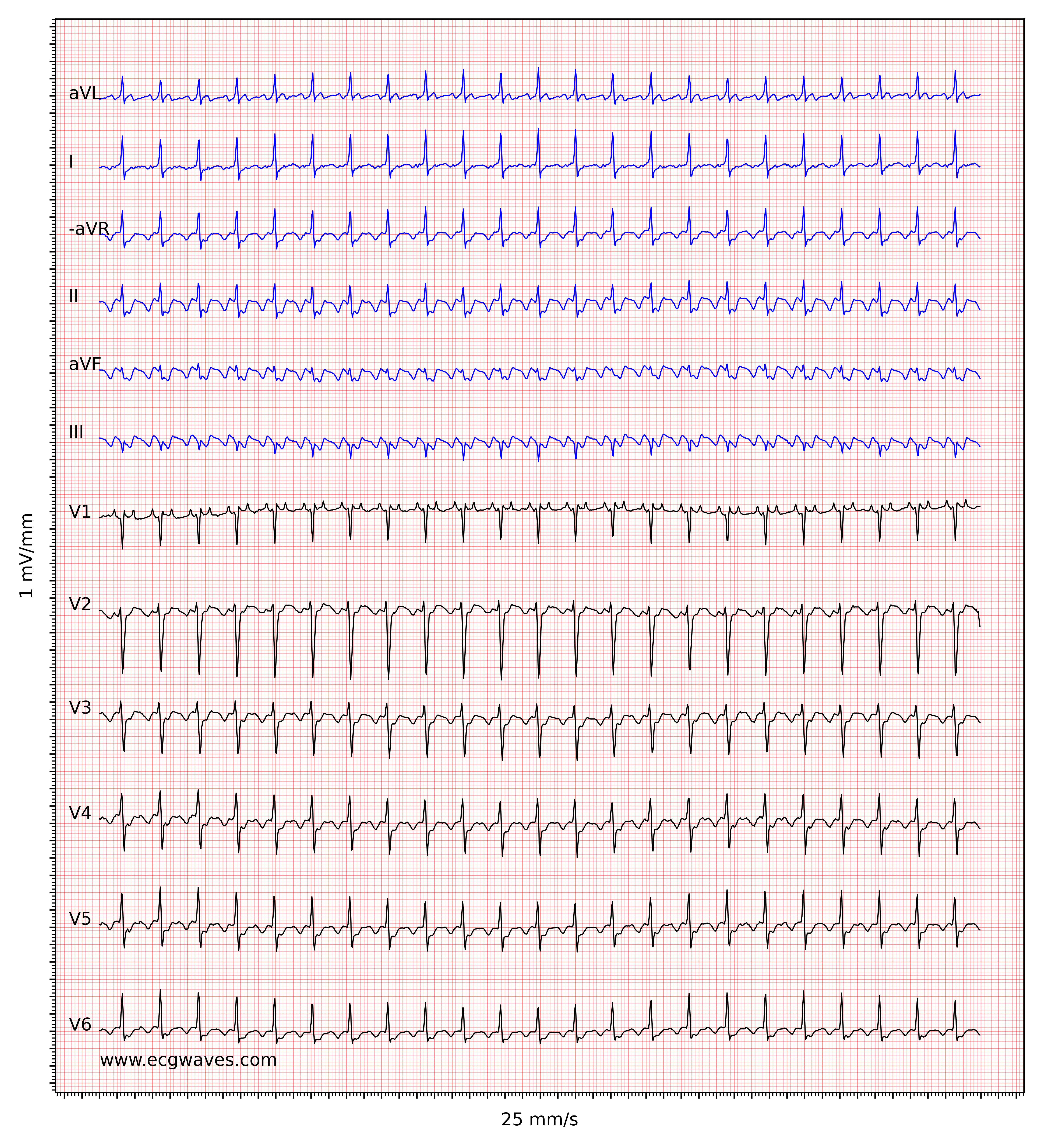 Ventricular Flutter