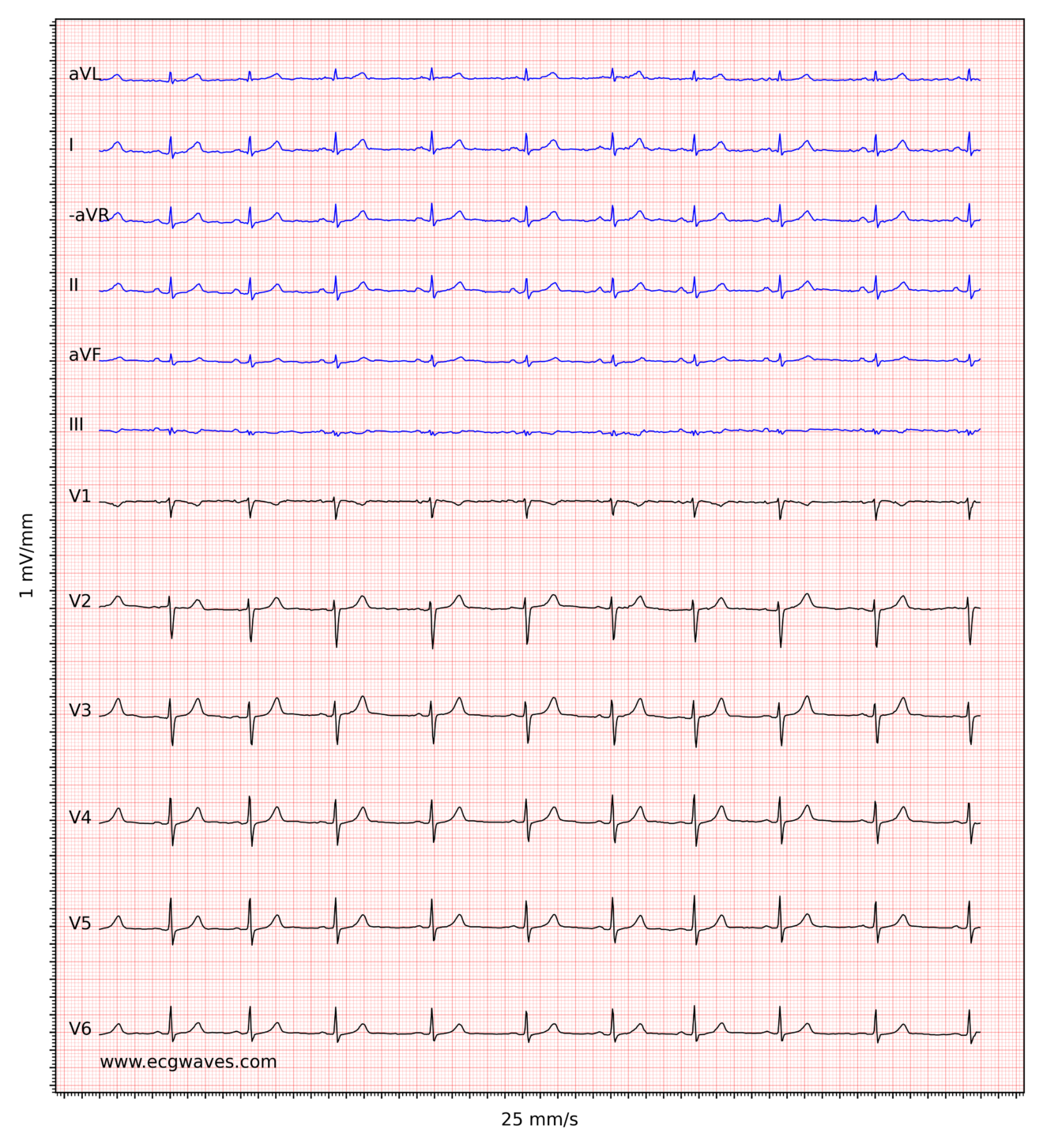 ECG interpretation Characteristics of the normal ECG (Pwave, QRS