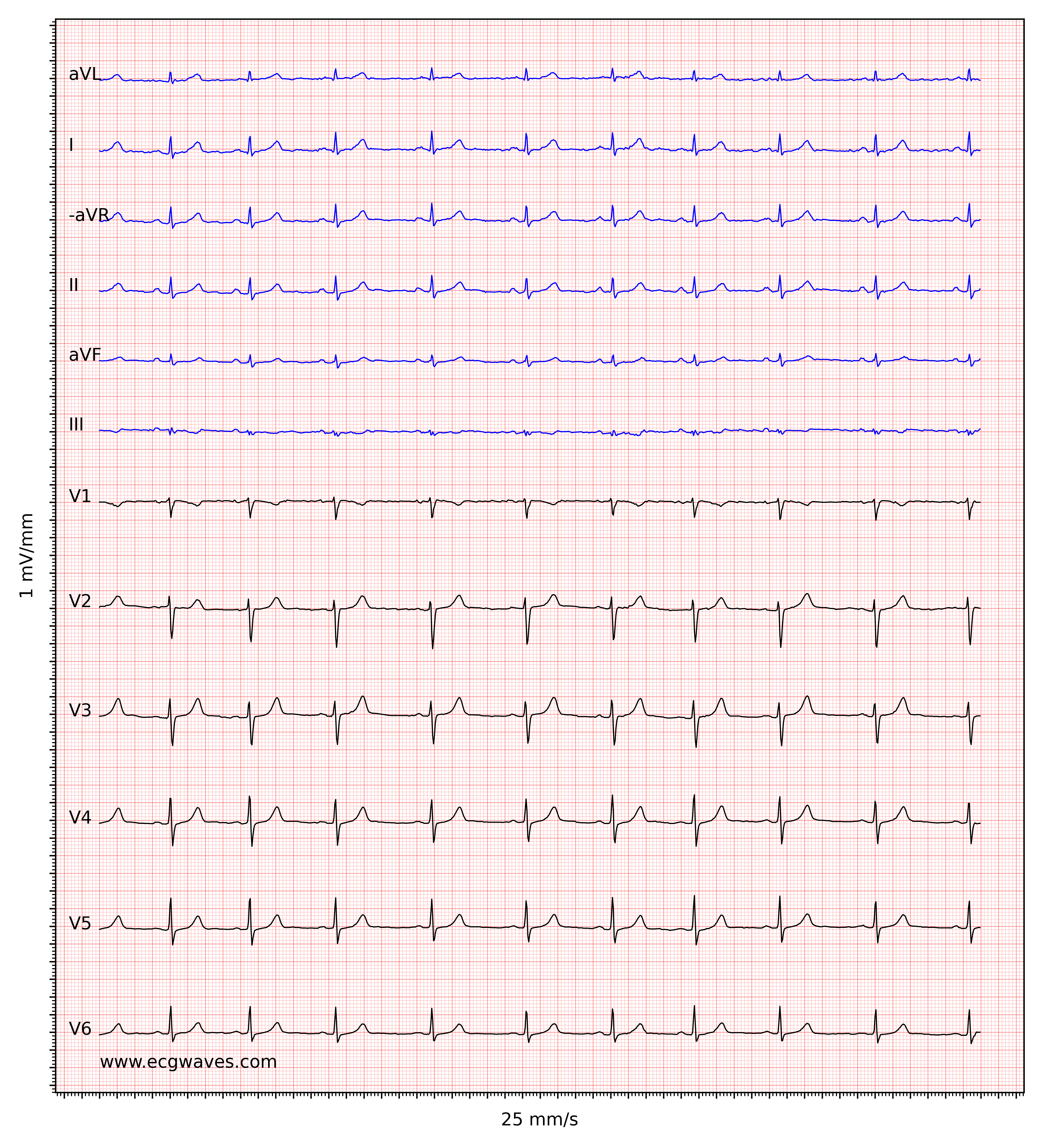 Normal Sinus Rhythm Normal Sinus Rhythm