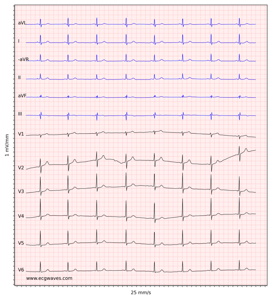 Figure 4. Sinus bradycardia.