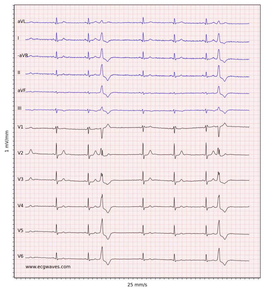 Figure 2. Sinus bradycardia, premature ventricular contractions, incomplete right bundle branch block and ST-segment depressions in V2-V6.