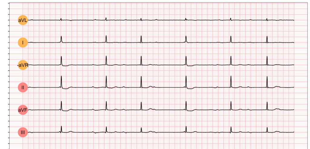 Second-degree atrioventricular block (fetal echocardiography