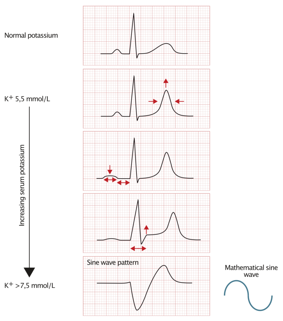 Figure 1. ECG changes seen in hyperkalemia.