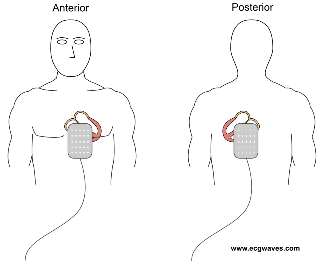 Figure 4. Placement of electrode pads in the anteroposterior direction for transcutaneous pacing.