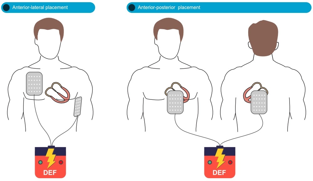 Large Randomized Trial: LUCAS Chest Compression System is Effective and  Reliable in Pre-Hospital Cardiac Arrest