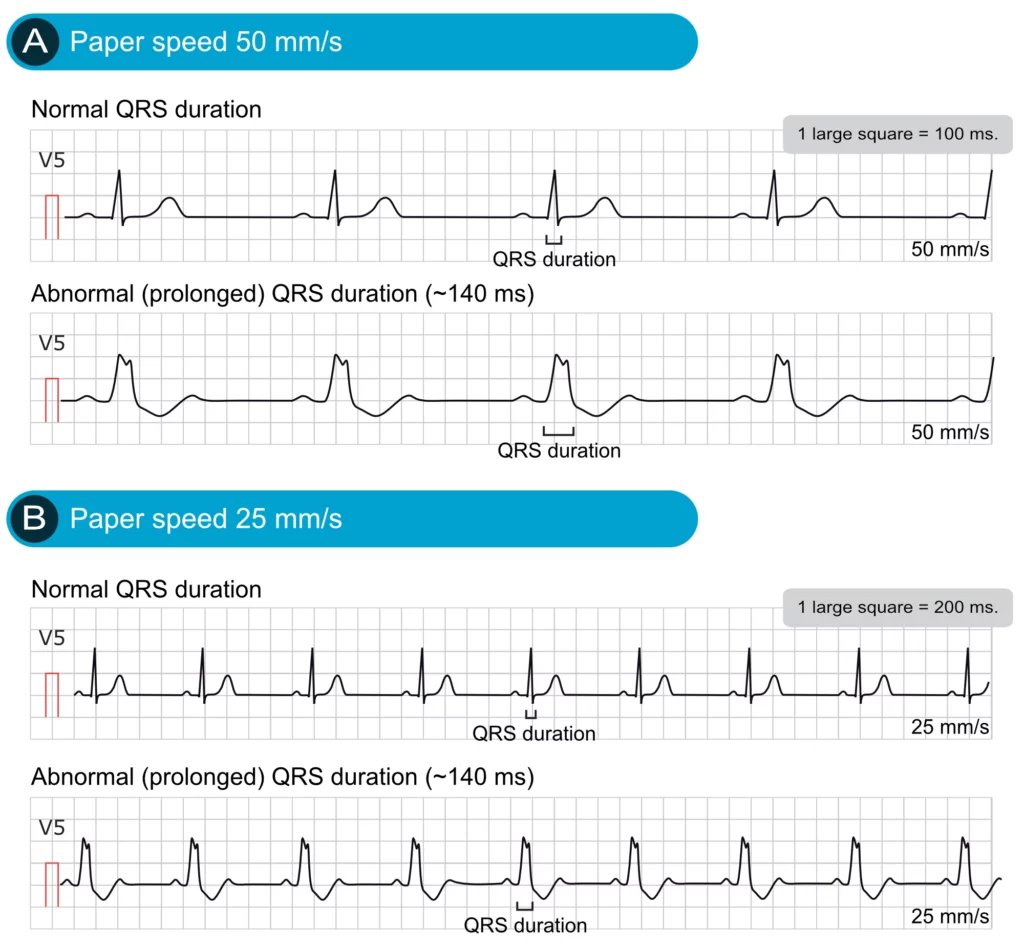 Killer ECG Patterns Part LITFL ECG Library 50 OFF