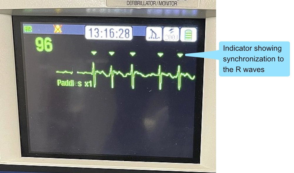 Large Randomized Trial: LUCAS Chest Compression System is Effective and  Reliable in Pre-Hospital Cardiac Arrest