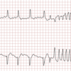 Cardiac Arrest and Resuscitation