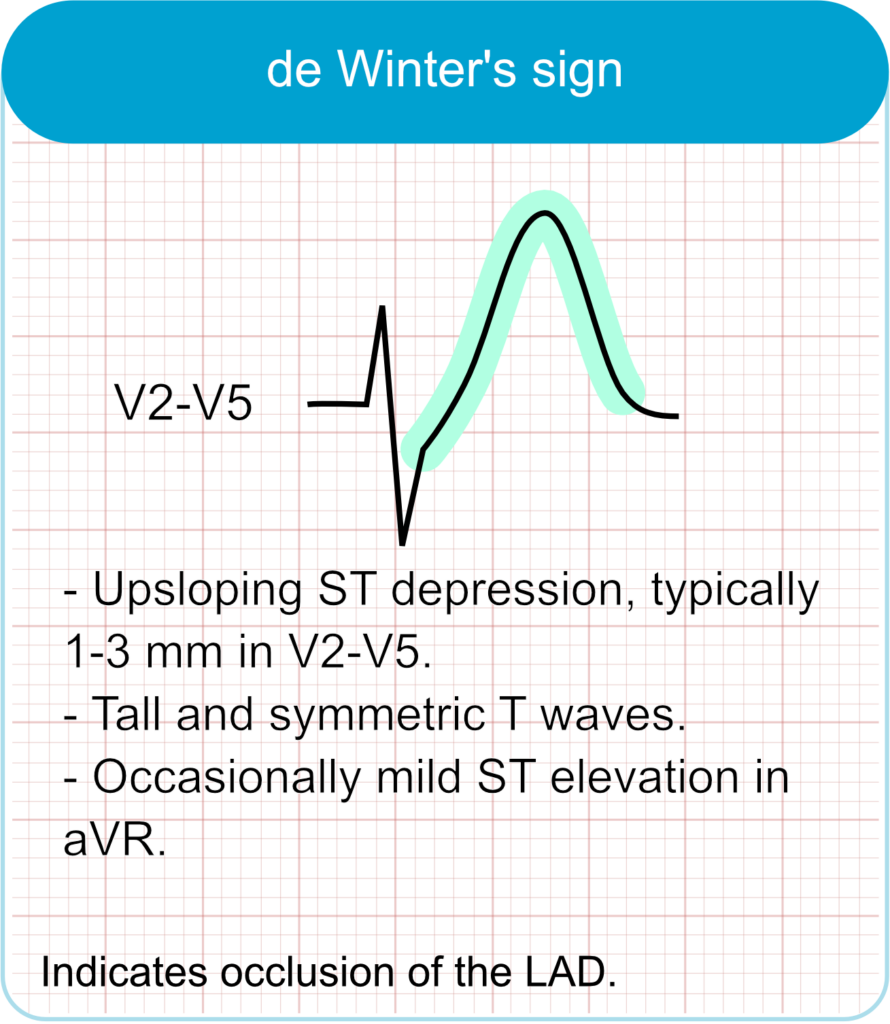 De Winter T-waves (De Winter sign)