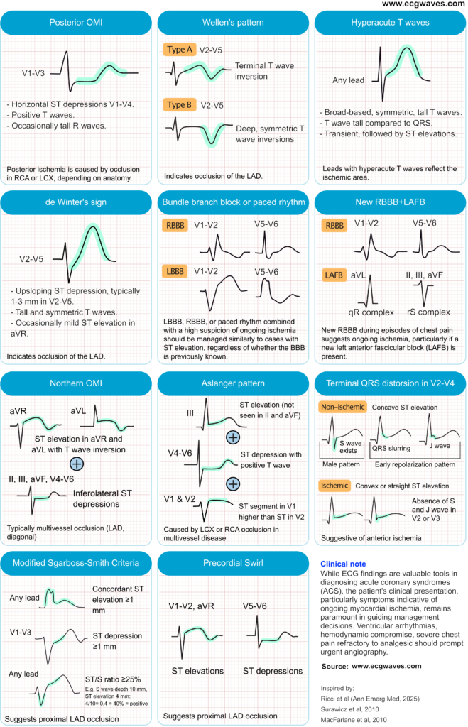 Figure 1. ECG patterns suggestive of acute coronary occlusion (ACO).