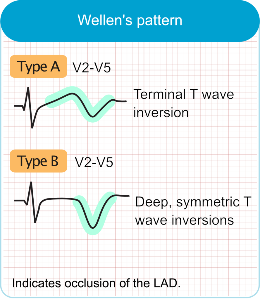 Wellens Syndrome (Wellens ECG pattern)